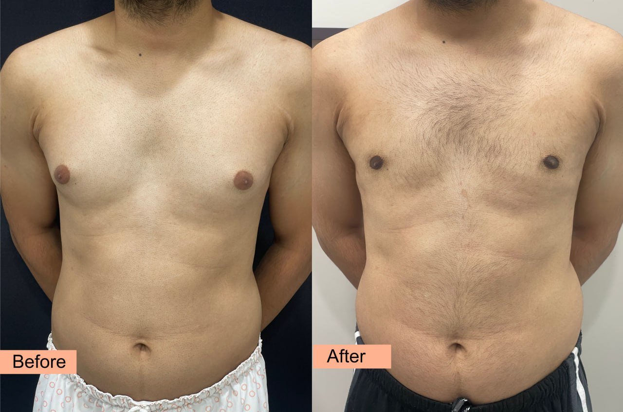 3-months postop gynecomastia results