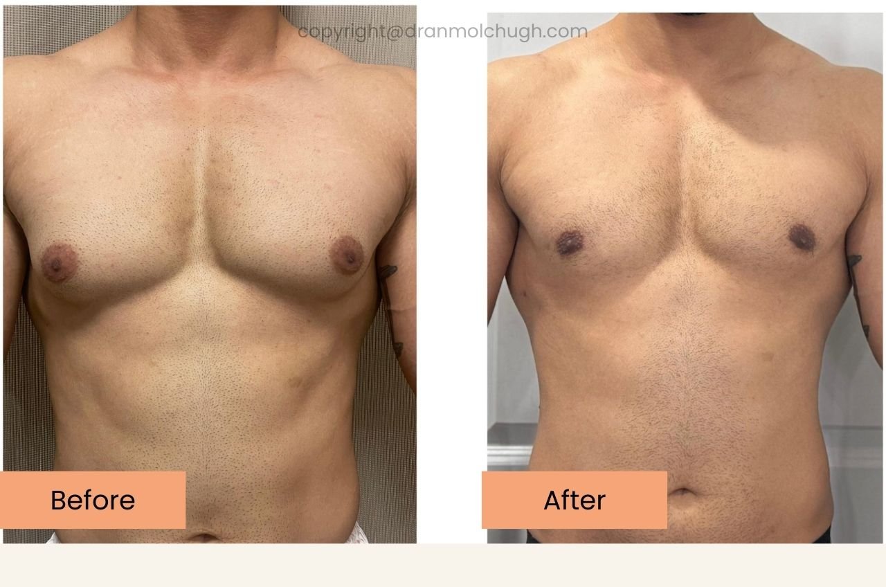 Gynecomastia surgery results in a 36 year old bodybuilder